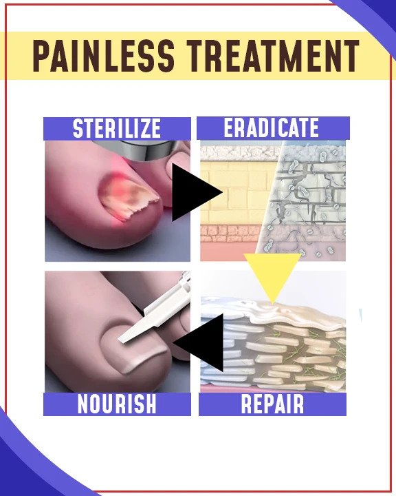 مجموعات العلاج بالضوء الأزرق المضادة للفطريات - الصورة 2
