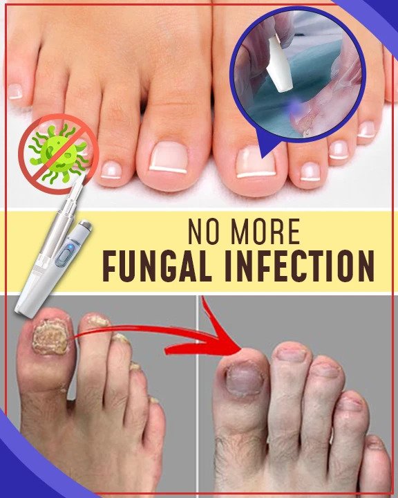 مجموعات العلاج بالضوء الأزرق المضادة للفطريات - الصورة 3