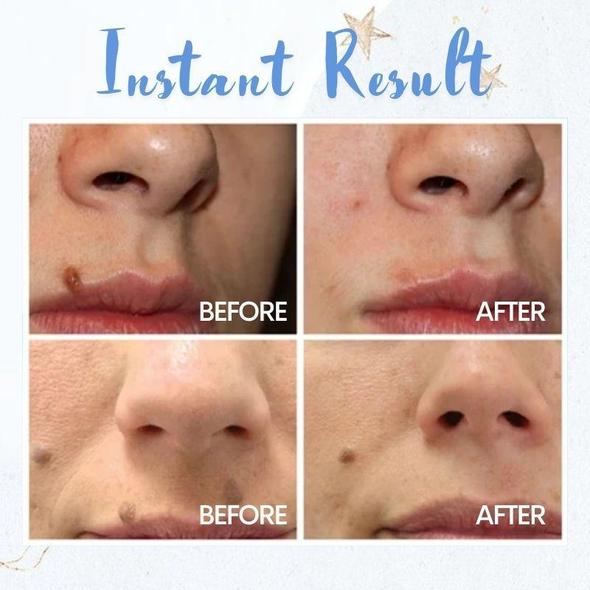 قلم إزالة البقع - الصورة 2